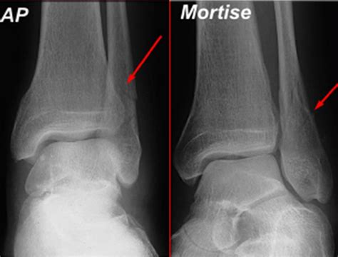Isolated Lateral Malleolus Fracture