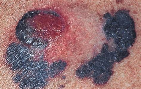 What Does Nodular Melanoma Look Like Symptoms Treatment And Risk