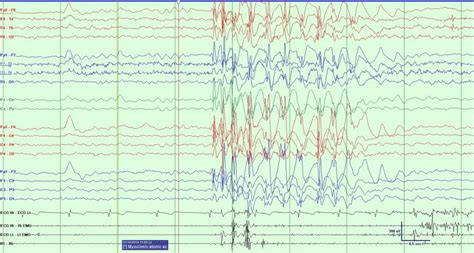 Ictal Eeg With Polygraphy Of A Myoclonicatonic Seizure Showing Initial