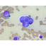 Plasma Cell Neoplasm  MyPathologyReportca