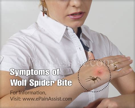 Wolf Spider Bitesymptomstreatmentpreventiondiagnosis