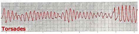 Med In Small Doses Ventricular Tachyarrhythmias Ivline