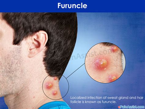 Boil Back Pain From Infection Of Hair Follicle Sweat Gland
