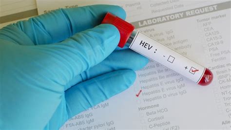 Eine überstandene erkrankung verleiht keine immunität. Hepatitis E: Infektion durch Schweinefleisch | NDR.de ...