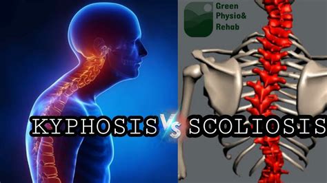 Kyphosis Vs Scoliosis Green Physio And Rehab Youtube