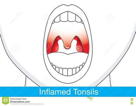 Tonsils Clipart 20 Free Cliparts Download Images On Clipground 2024