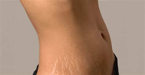 10 Remedies To Get Rid Of Stretch Mark And It Actually Works