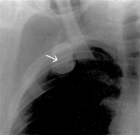 Isolated First Rib Fracture In Athletes British Journal Of Sports