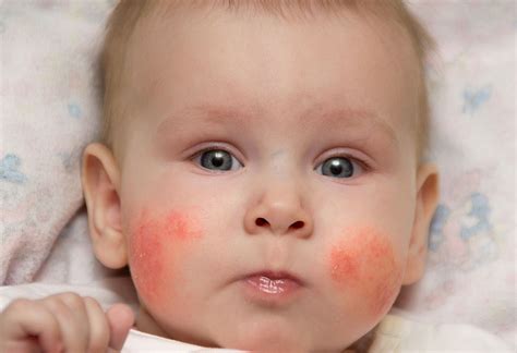 Allergy Trigger Skin Rash On Face Child