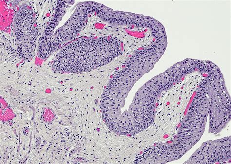 Pathology Outlines Polypoid Papillary Cystitis