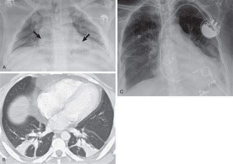 Chest Radiography In The Intensive Care Unit Radiology Key