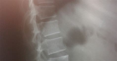Dicas De Radiologia Tudo Sobre Radiologia Radiografia Demonstrando Esclerose Ssea Na Coluna
