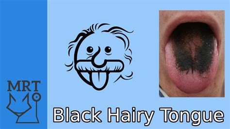 Black Hairy Tongue Mini Medical School Youtube