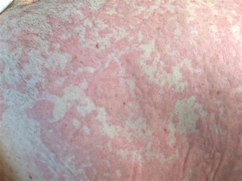 Urticaria Hives Symptoms Causes And Treatment
