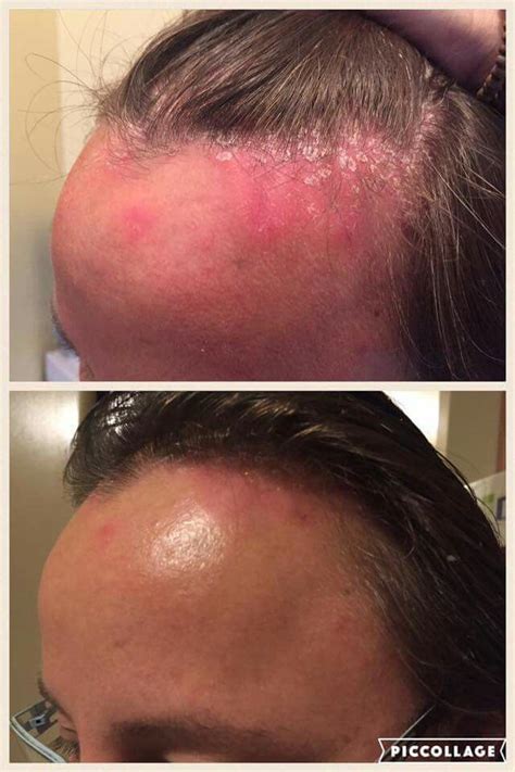 Scalp Treatment For Psoriasis Hair Loss Treatment Cure Dry Skin