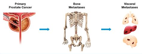 PDF Bone Metastases Mortality In Prostate Cancer Can We Be Doing More Semantic Scholar