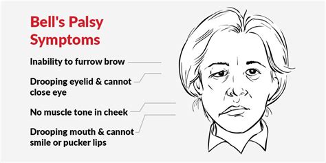 Drooping Face How To Treat Bells Palsy With Physiotherapy Pt Health