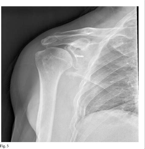 Figure 5 From Arthroscopically Assisted Reduction And Internal Fixation