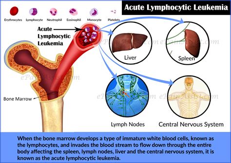Acute Lymphocytic Leukemiaprognosissurvival Ratetreatmentdiagnosis