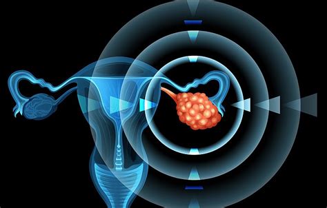 Ovarian Cancer Clot Risk High In All Phases Of Treatment Clearity