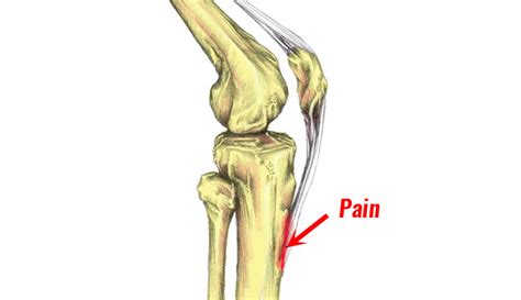 Osgood Schlatter Disease How To Treat And Manage It In Adolescents
