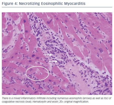Figure 4 Necrotizing Eosinophilic Myocarditis Radcliffe Cardiology
