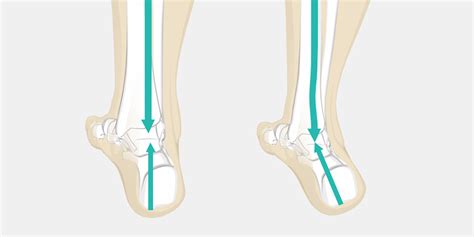 Pronation The Complete Injury Guide Vive Health