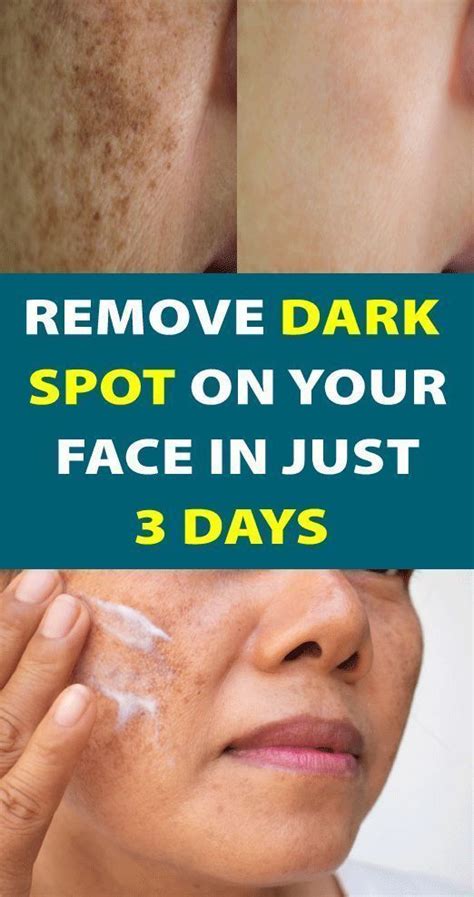 Simple Trick To Remove Brown Spots From Your Skin Remove Dark Spots
