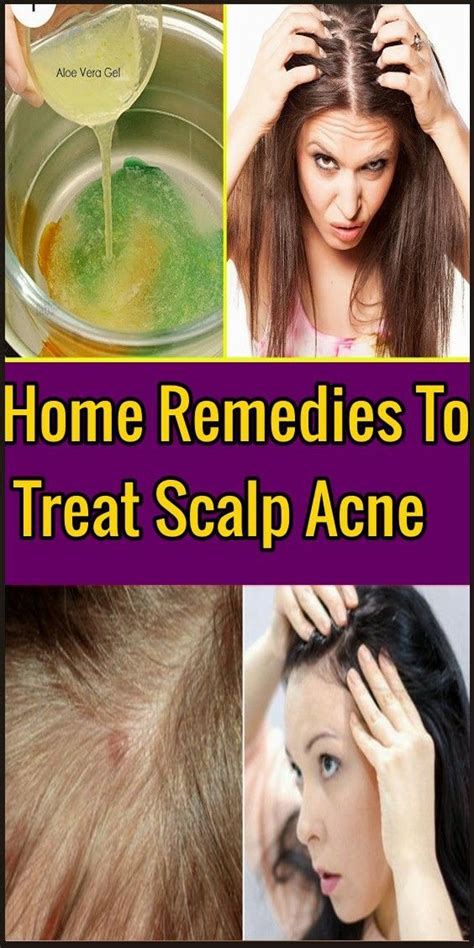 Home Remedies To Treat Scalp Acne How To Treat Scalp Acne Scalp