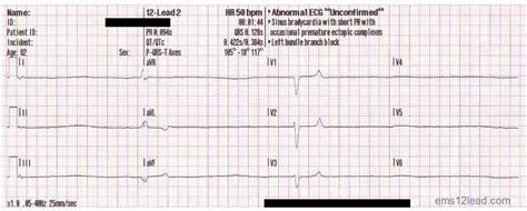 Ems 12 Lead Bradycardia Post Part Ii Rogue Medic