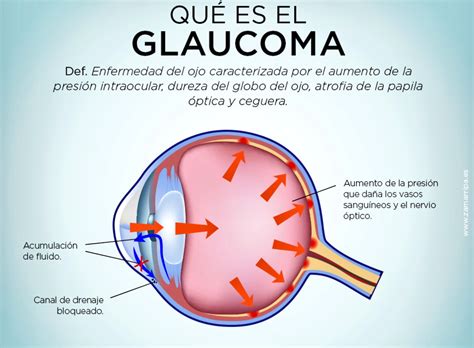 Glaucoma is the result of damage to the optic nerve. Fundasalud Trujillo on Twitter: "#DíaMundialDelGlaucoma ...