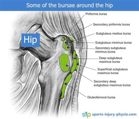Interesting Facts About Hip Trochanteric Bursitis Sports Injury Physio