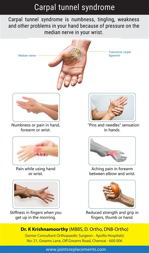 Carpal Tunnel Syndrome A Numbness And Tingling In The Hand And By