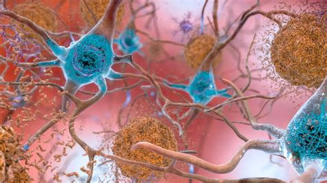 New Hope For Deadly Alzheimer’s As Scientists Track How Brain Cells Die The Early Signs To