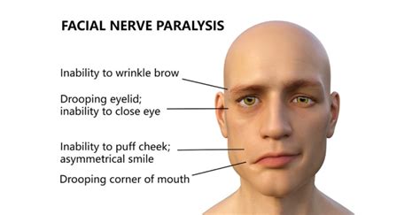 Facial Palsy Awareness Pmc Physiotherapy Dunboyne Chartered