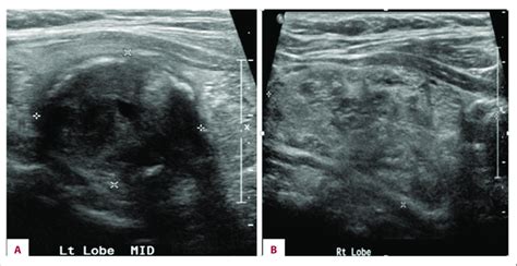 A B Ultrasonography Of Thyroid Gland Showing Abnormal Texture With