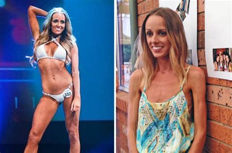 Happy Ending As Anorexia Sufferer Conquers Illness As Bikini Beauty
