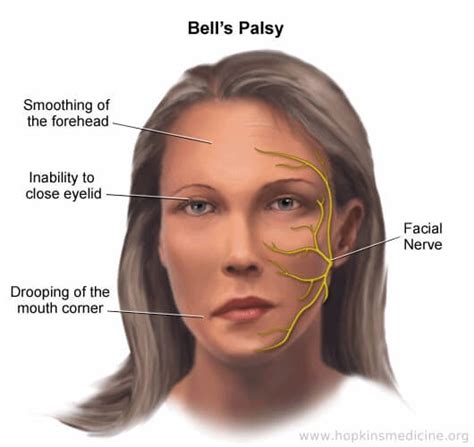 Bell S Palsy Causes Symptoms Diagnosis And Treatment
