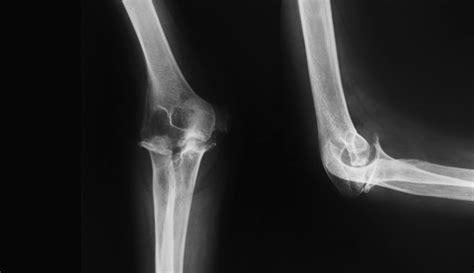 Elbow X Ray Anatomy Procedure And What To Expect