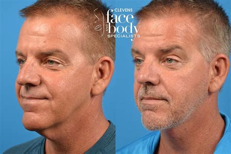 transformative male neck lift before and after