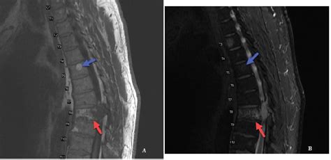 A A 61 Year Old Male With Hemangioma Of The Thoracic Spine Sagittal