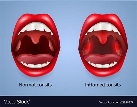 Infected Tonsils Inflammation Concept Royalty Free Vector