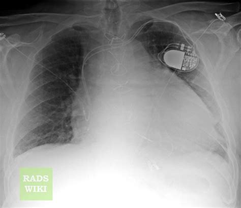 Pericardial Effusion Chest X Ray Wikidoc