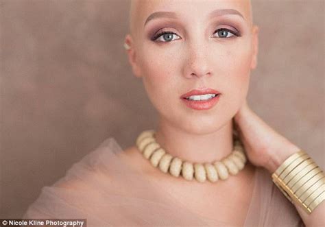 Bride With Alopecia Goes Bald On Her Wedding Day Daily Mail Online