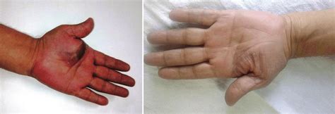 Clinical Photograph Showing Left Pretreatment Lesion Single Soft