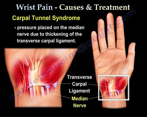 Wrist Paincauses And Treatment Part I Everything You Need To Know