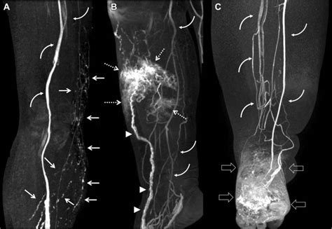 Lower Limb Lymphedema Staging Based On Magnetic Resonance