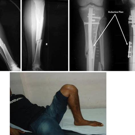Patient With A Segmental Tibial Fracture Treated With Expert Tibial