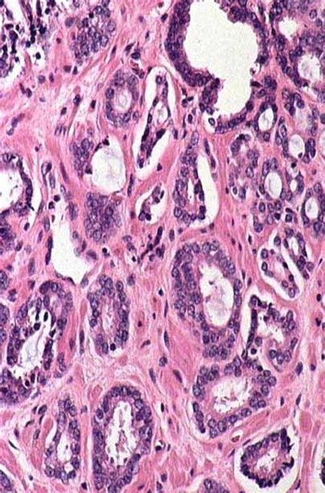 Adenocarcinoma Acinar Usual Gleason 3 3 6