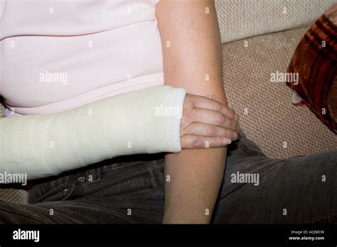 A Female With A Cast On Her Broken Arm Stock Photo Alamy